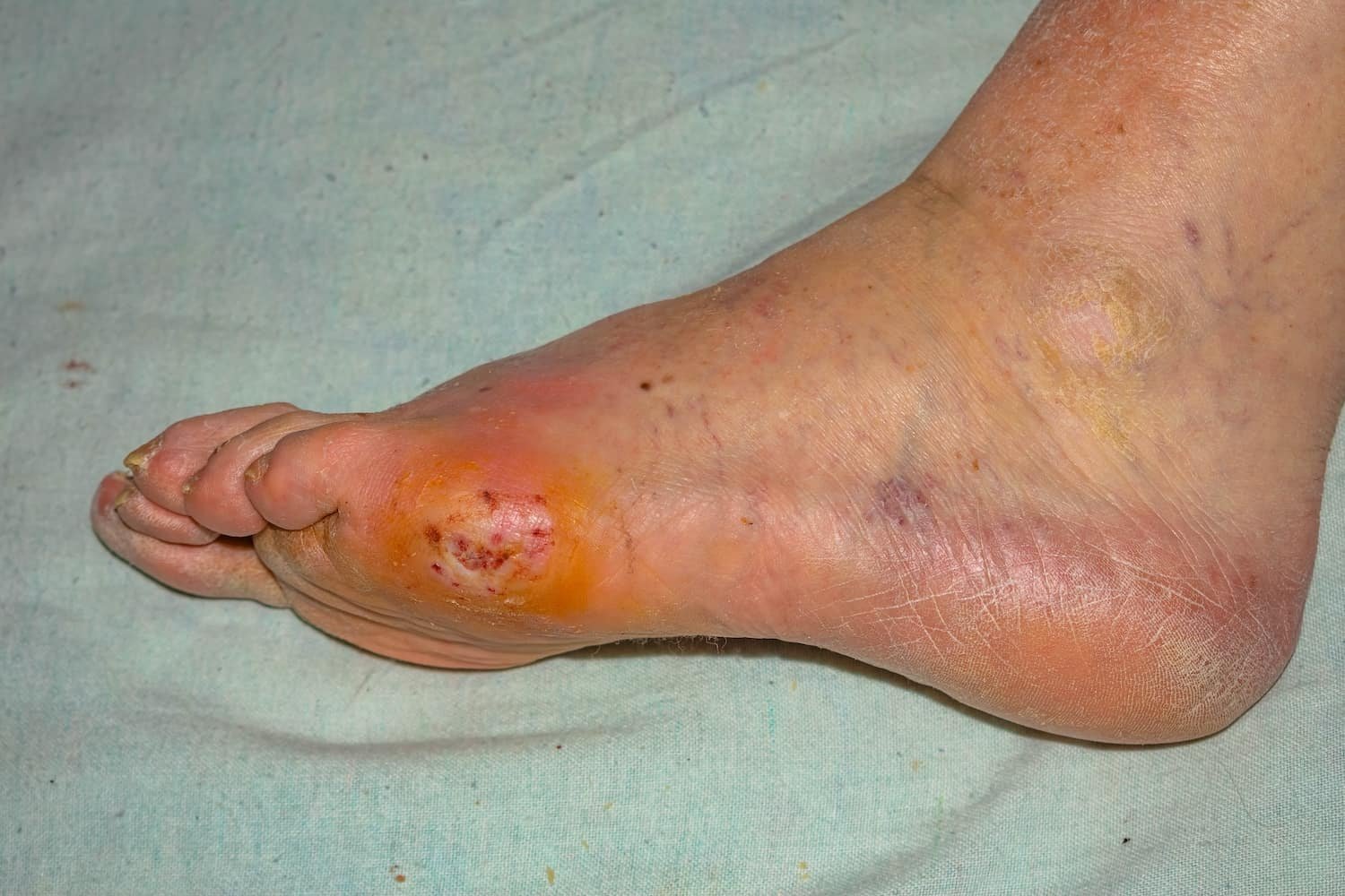 Diabetic Peripheral Neuropathy